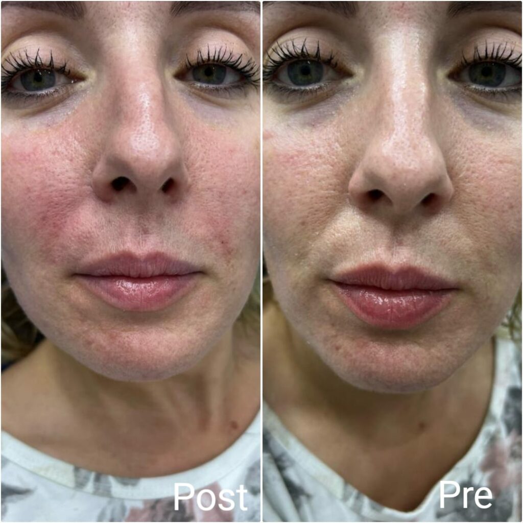 حقن فيلر خط الابتسامة